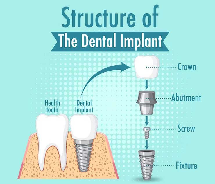 dental-implant-cost-in-dubai-explained-simply-big-0