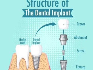 Dental Implant Cost in Dubai Explained Simply