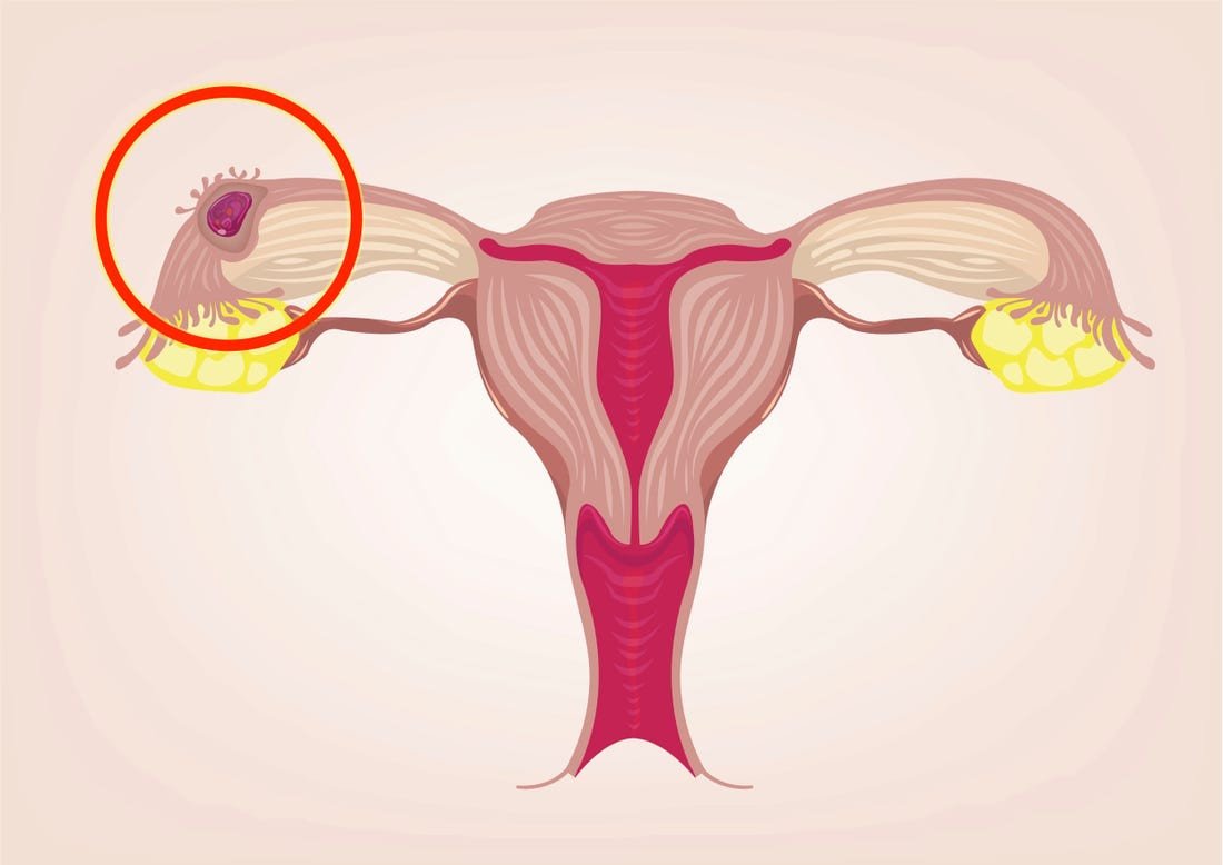 understanding-ectopic-pregnancy-causes-symptoms-and-risks-big-0