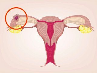 Understanding Ectopic Pregnancy: Causes, Symptoms, and Risks