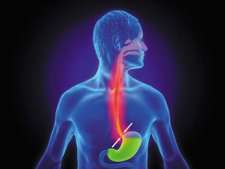 Understanding Heartburn and Its Treatment Options in Dubai