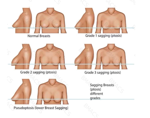 breast-lift-with-suture-suspension-in-windsor-big-0