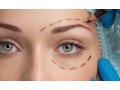 eyelid-lift-surgery-windsor-book-blepharoplasty-consultation-in-ealing-small-0
