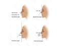 non-surgical-nose-reshaping-in-chiswick-quick-painless-treatment-small-0