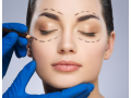 eyelid-surgery-in-windsor-bmacs-small-0