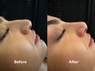 Non-Surgical Nose Reshaping in Chiswick – Book Your Consultation Today