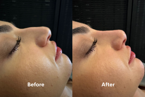 non-surgical-nose-reshaping-in-chiswick-book-your-consultation-today-big-0
