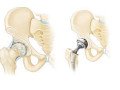 hip-joint-replacement-in-coimbatore-hip-bone-replacement-surgery-in-coimbatore-small-0