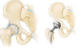 hip-joint-replacement-in-coimbatore-hip-bone-replacement-surgery-in-coimbatore-big-0