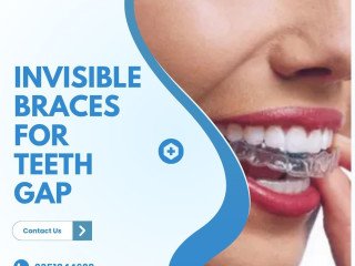 Invisible Braces for Teeth Gap| Singhvi Dental Clinic