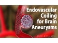 endovascular-coiling-for-brain-aneurysm-treatment-small-0