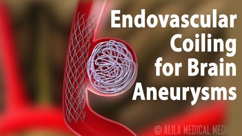endovascular-coiling-for-brain-aneurysm-treatment-big-0