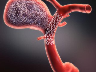 Aneurysm Coiling Procedure for Safer Brain Aneurysm Treatment