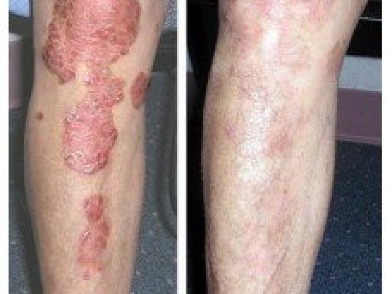 arogyam-pure-herbs-kit-for-psoriasis