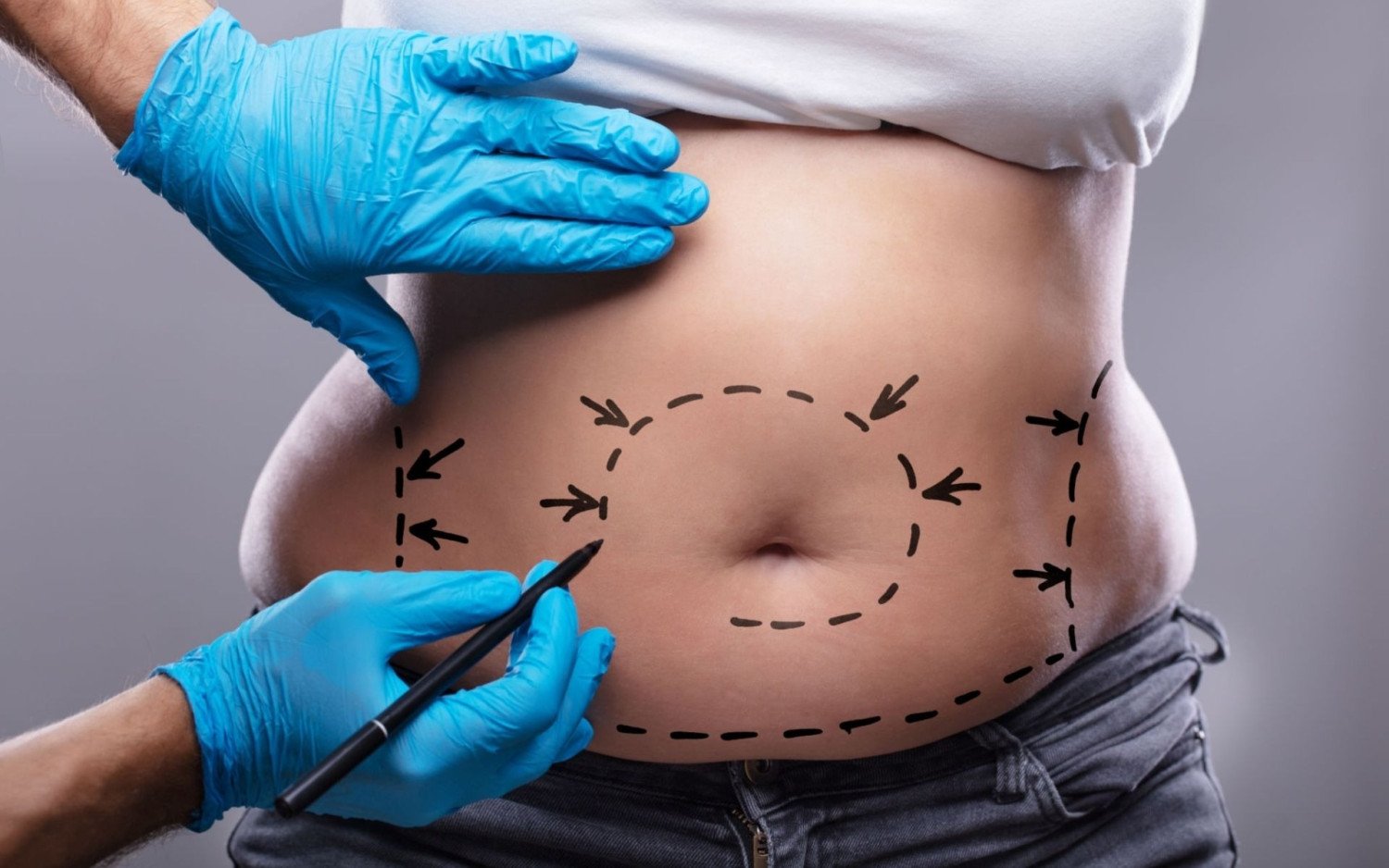 tummy-tuck-with-lipo-near-me