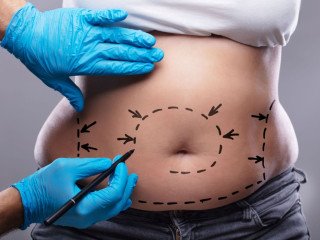 Tummy Tuck With Lipo Near Me